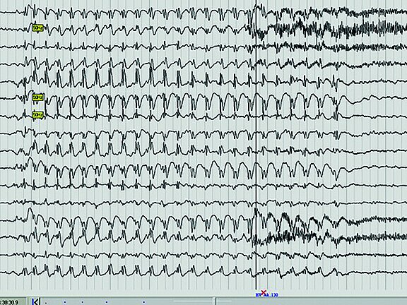 Abbildung eines EEG-Kurvendiagramms.