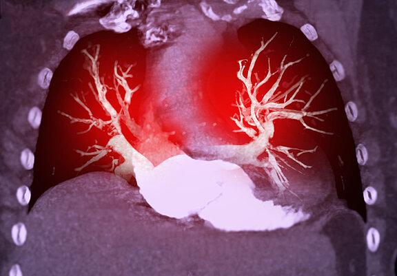 Darstellung der Lungengefäße im CT.
